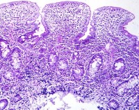 Corte histológico de yeyuno celíaco Corte histológico de yeyuno celíaco